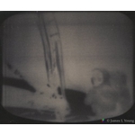 Neil Armstrong (probably) standing on moon. The TV image looked like a negative. (07-21-1969 UTC) Apollo 11 lunar landing